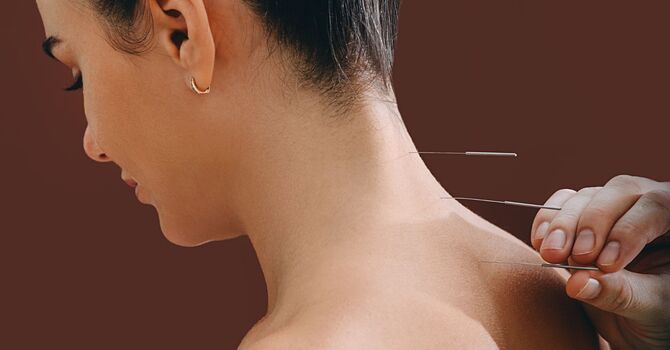 Dry Needling